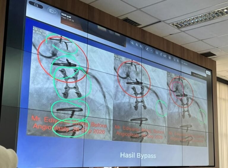 Mediasi Kasus Guidewire Tertinggal di Jantung Ediyanto Belum Temui Titik Temu, Begini Kronologinya
Telah dibaca : 651 Kali.